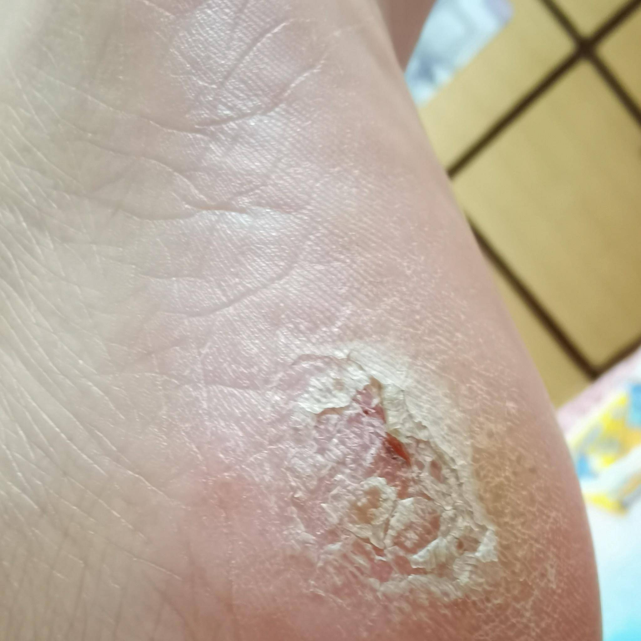 脚后跟裂开口子怎么办