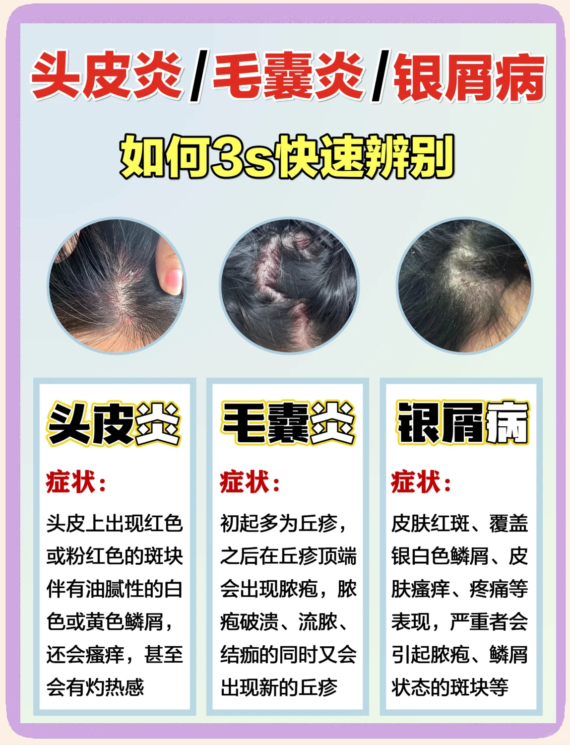 银屑病会遗传吗