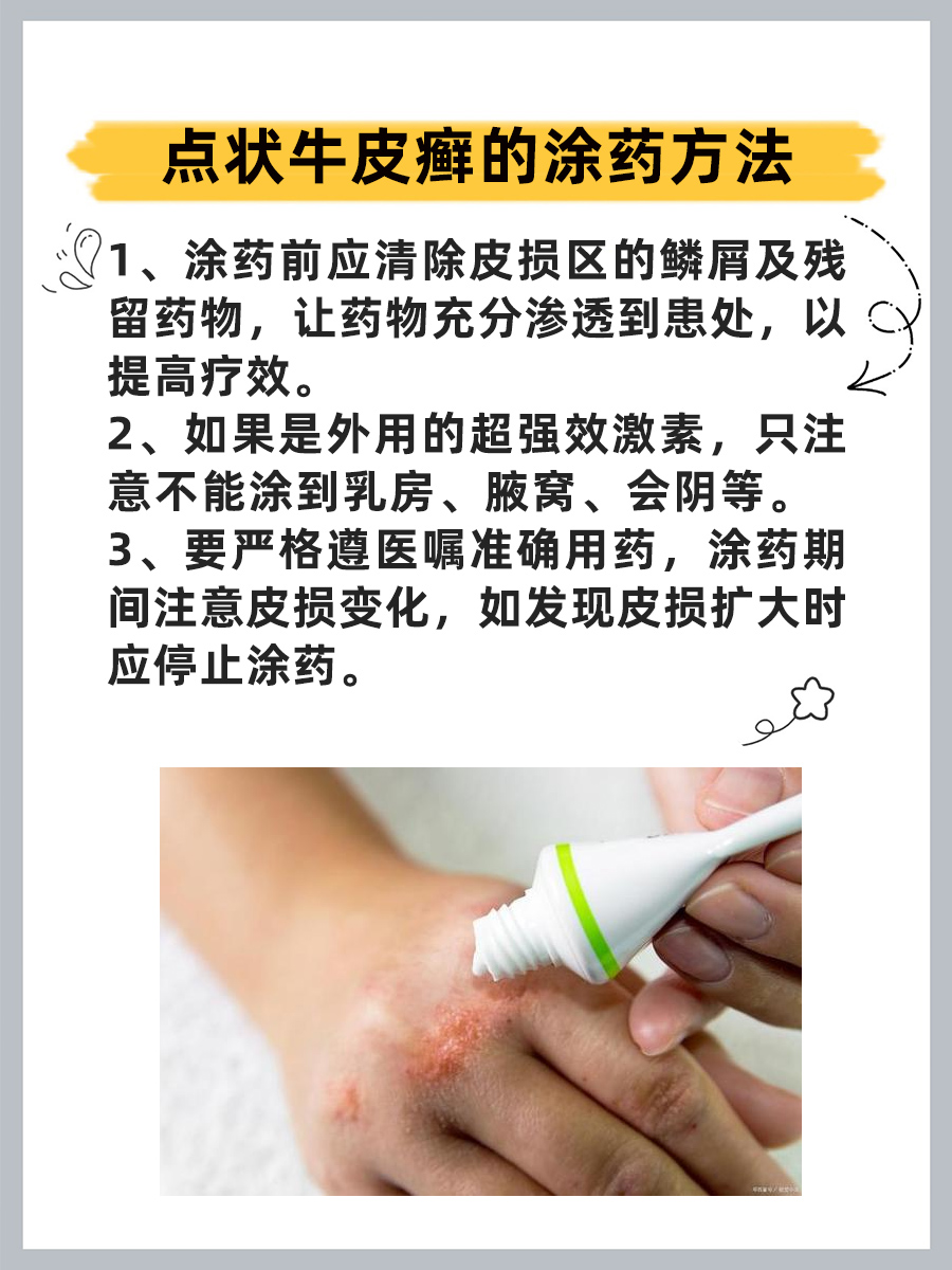 银屑病怎么治疗的最好