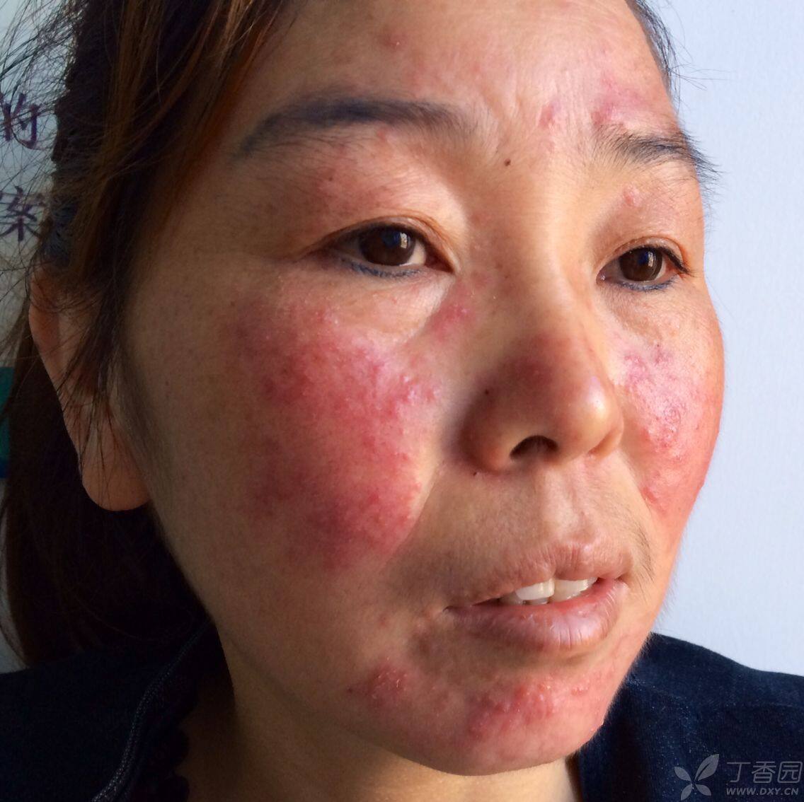 什么是激素依赖性皮炎?