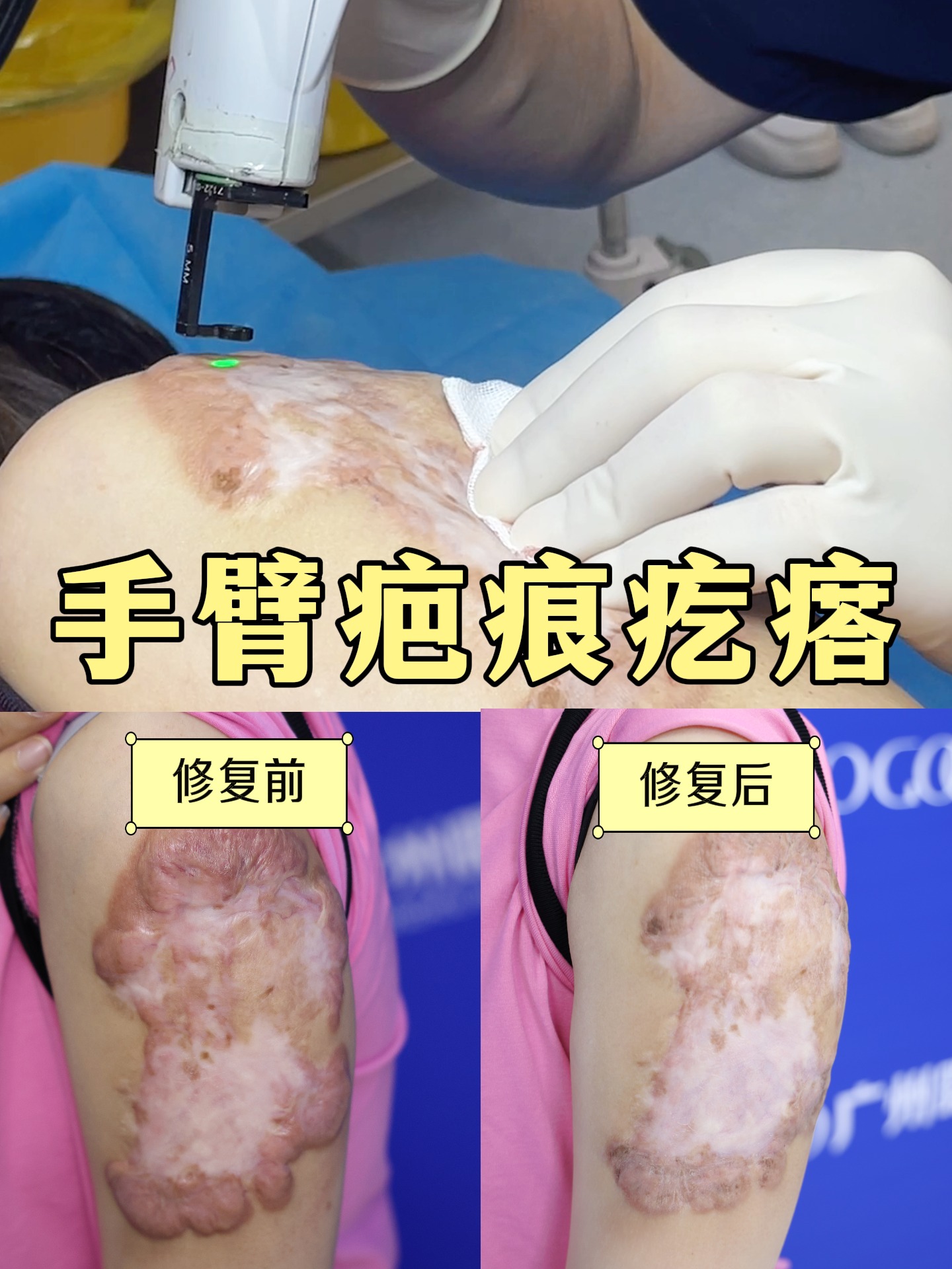 疤痕疙瘩能治好吗?