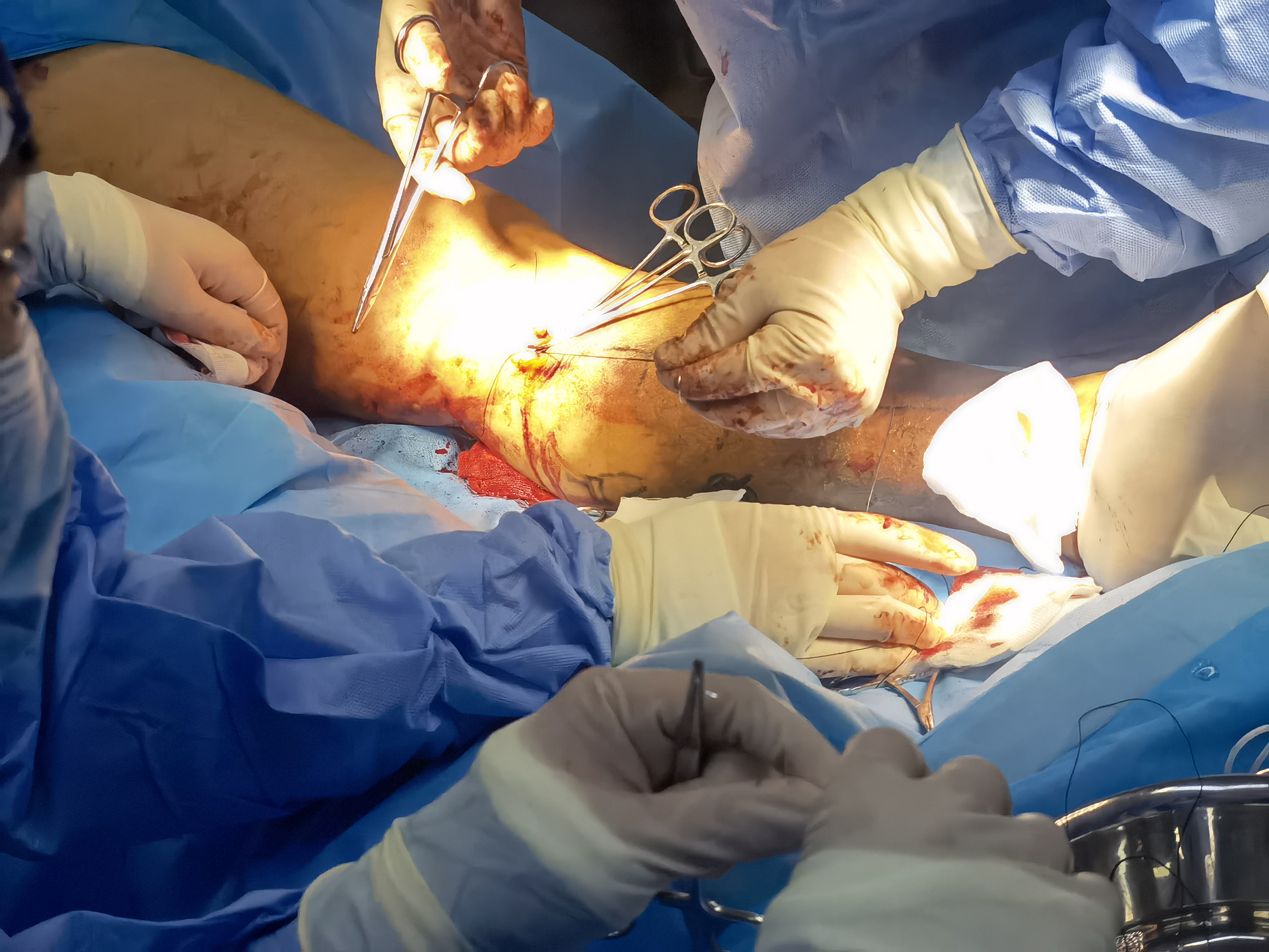 无痛引产手术过程