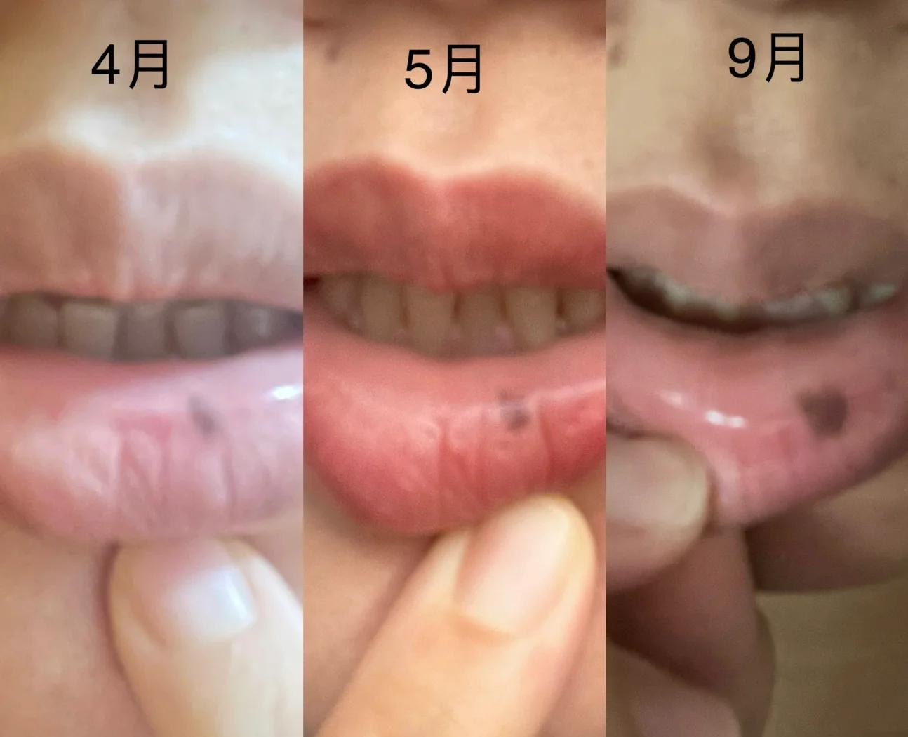 嘴唇发紫黑是怎么回事