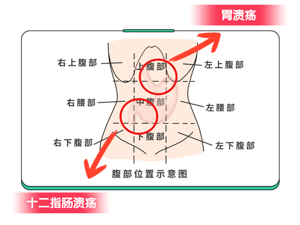 12指肠溃疡怎么治疗