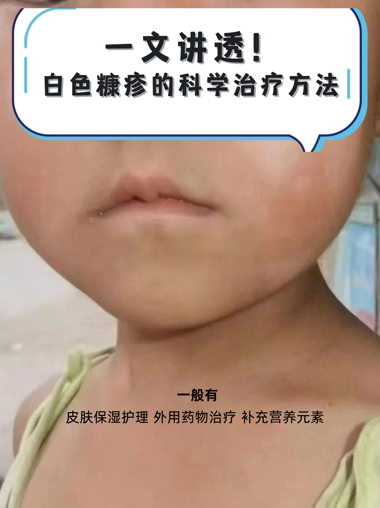 白色糠疹如何治疗