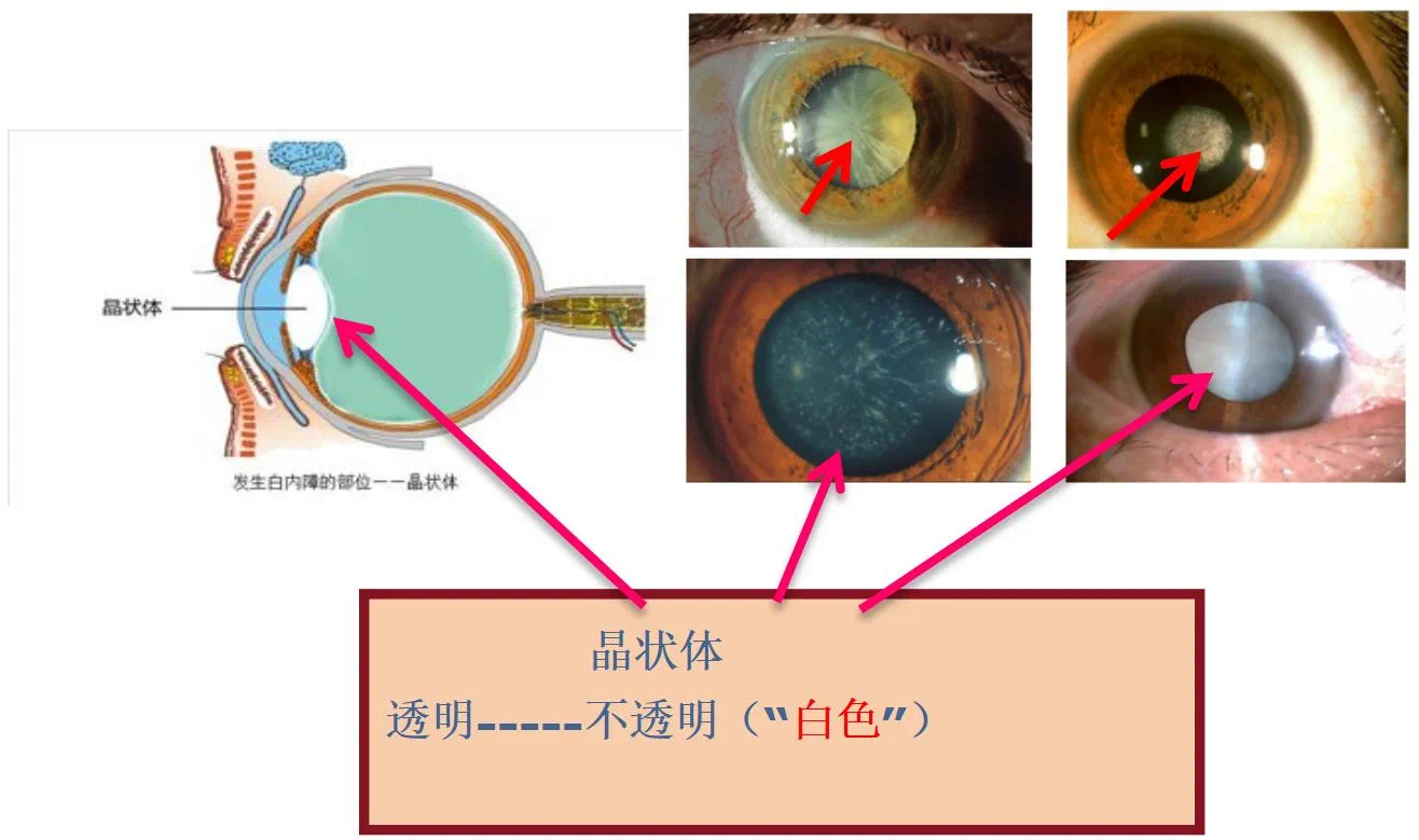 引发白内障的原因