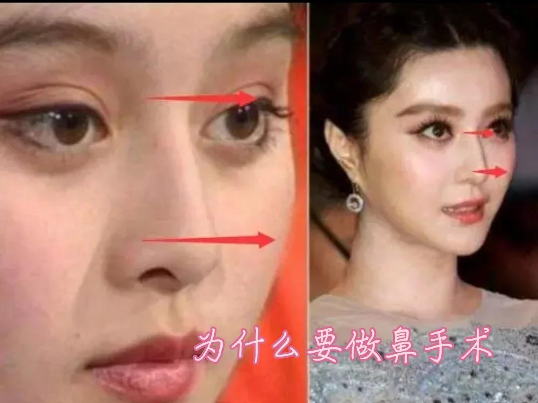 鼻梁两次侧有骨头突出来