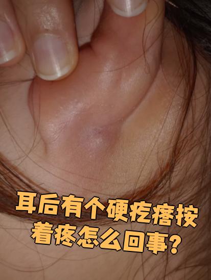 耳朵后面长了个硬包怎么办