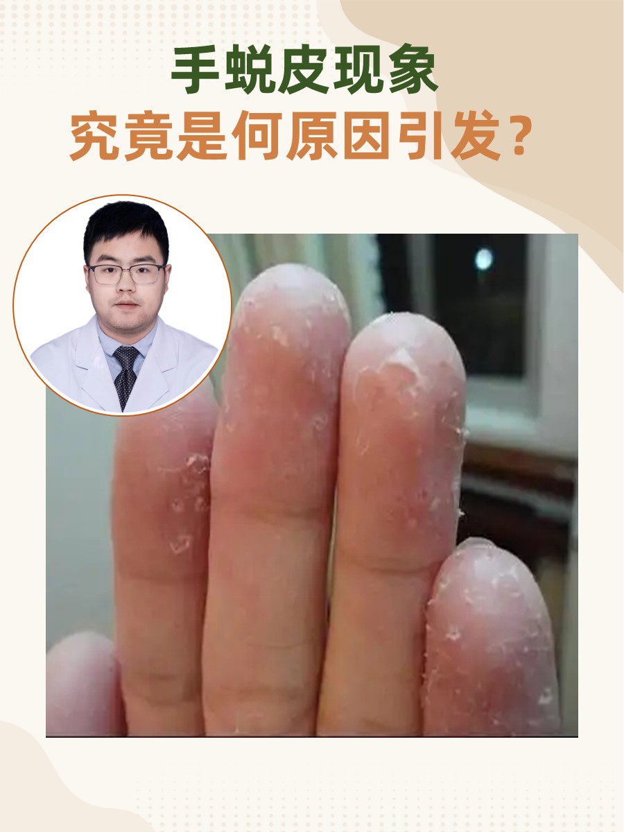 怎样治手脱皮