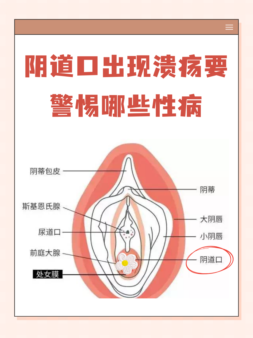 软下疳的症状一般有哪些?