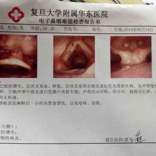 喉白斑病的症状和治疗