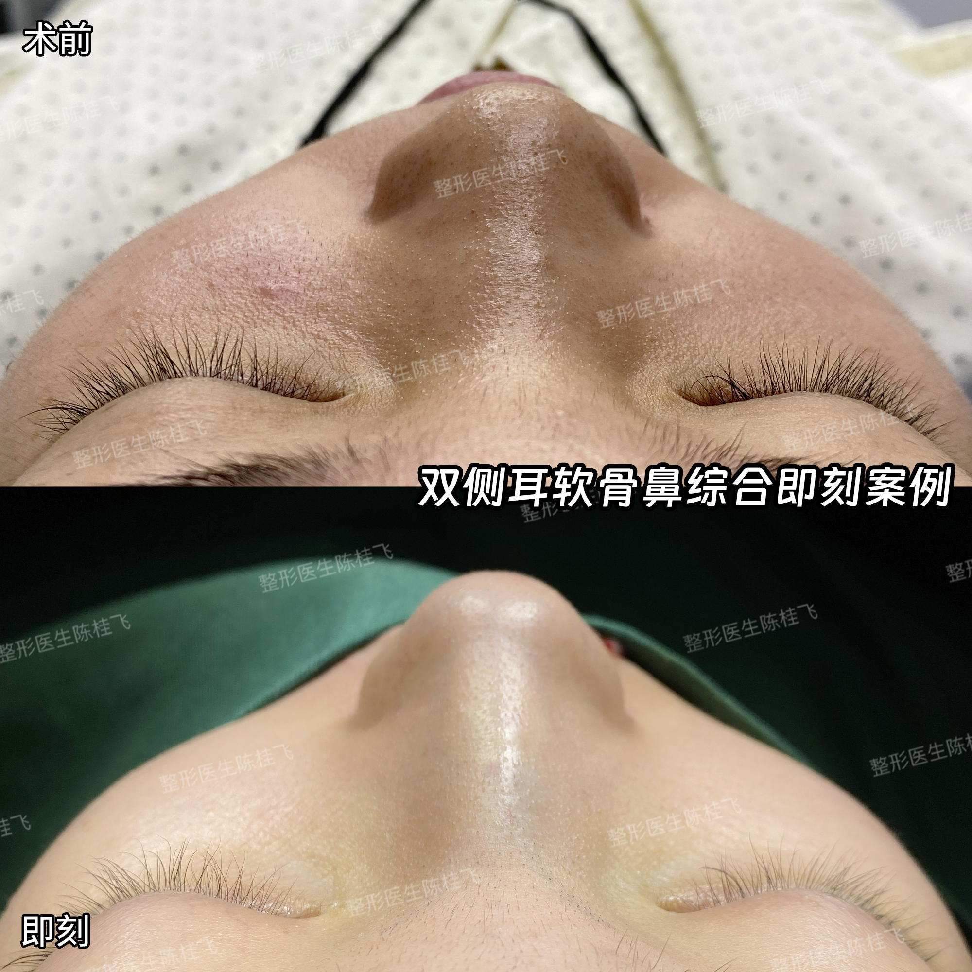 鼻子整形手术成功率怎么样?