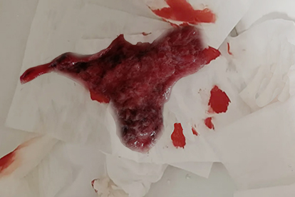 药流第三天排出来血块了