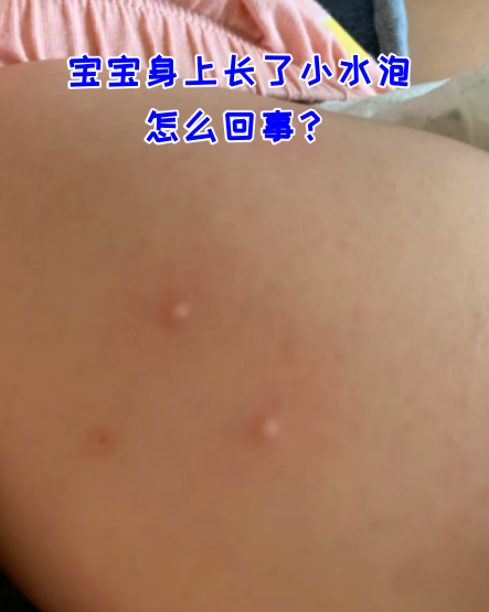 宝宝起水痘怎么办?