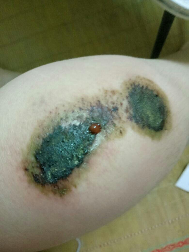 伤口结痂后又化脓了怎么办