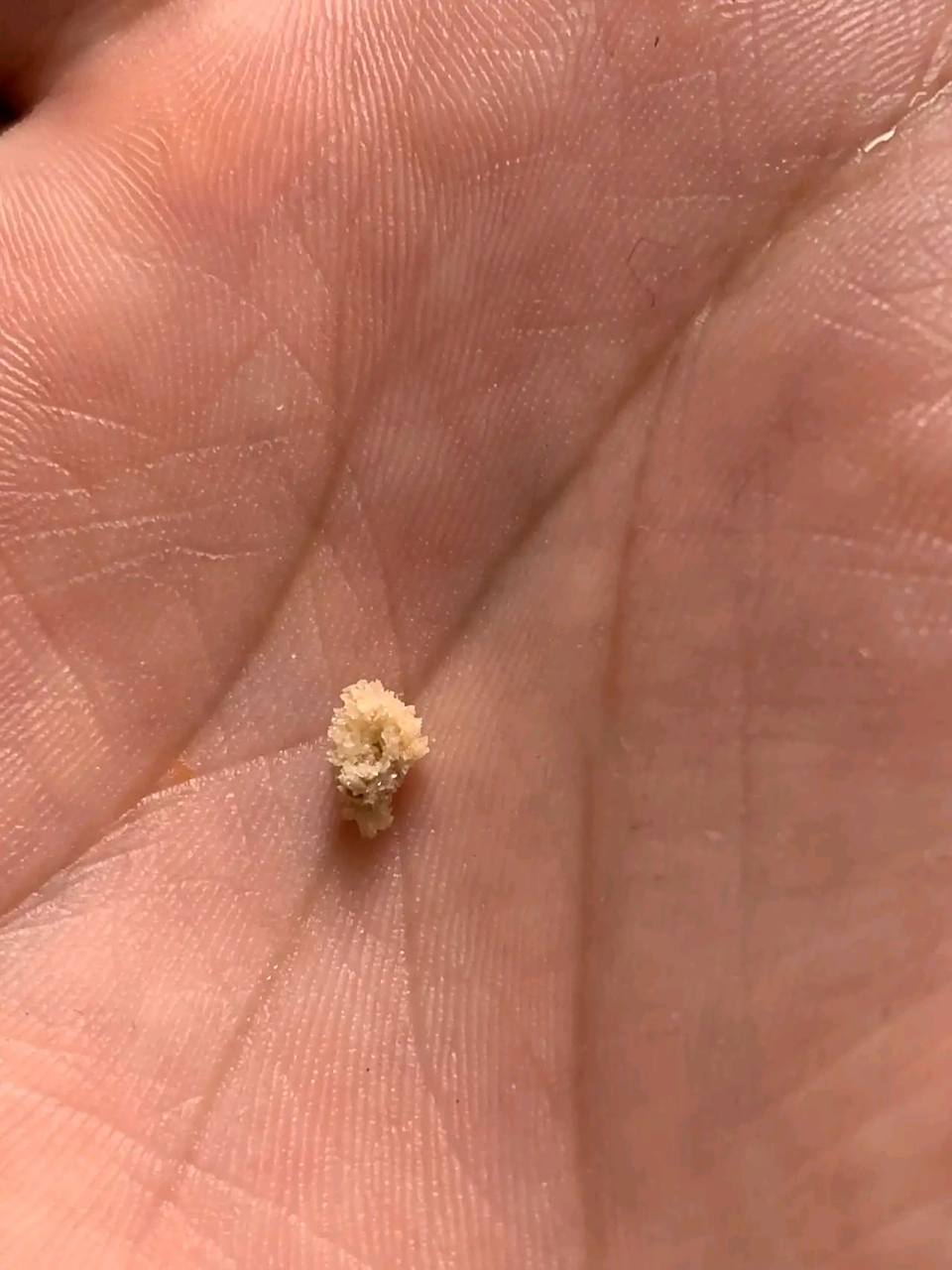 肾结晶的早期症状