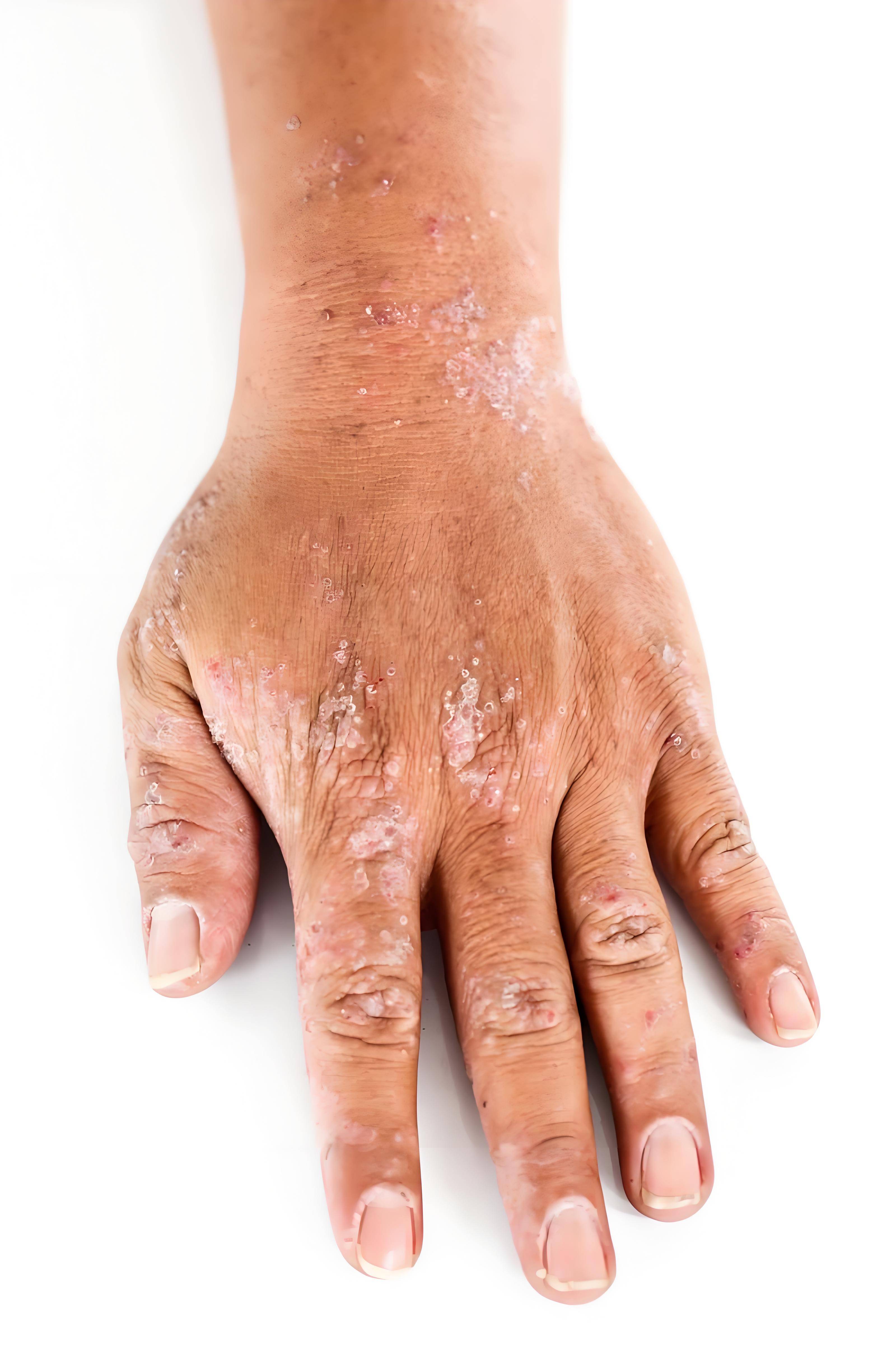 皲裂性湿疹有哪些表现