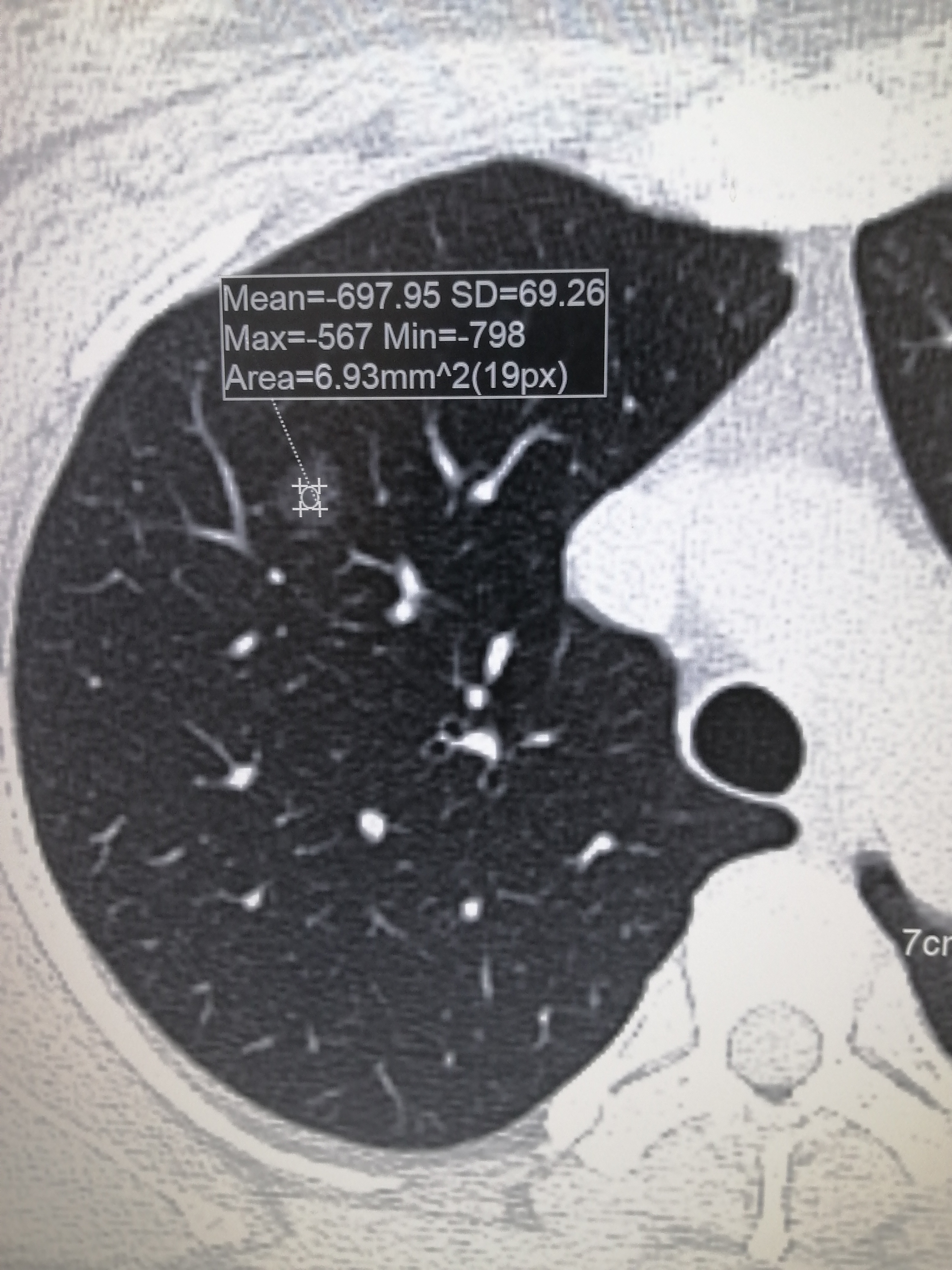右肺上叶磨玻璃结节7mm