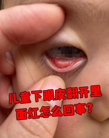 宝宝有眼屎眼睛红怎么办