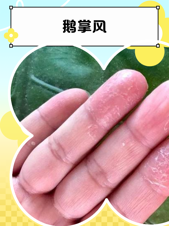 鹅掌风怎么治疗能除根吗