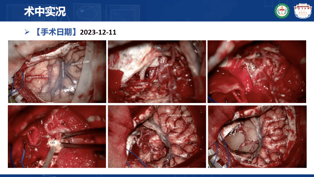 胶质瘤是癌症吗?