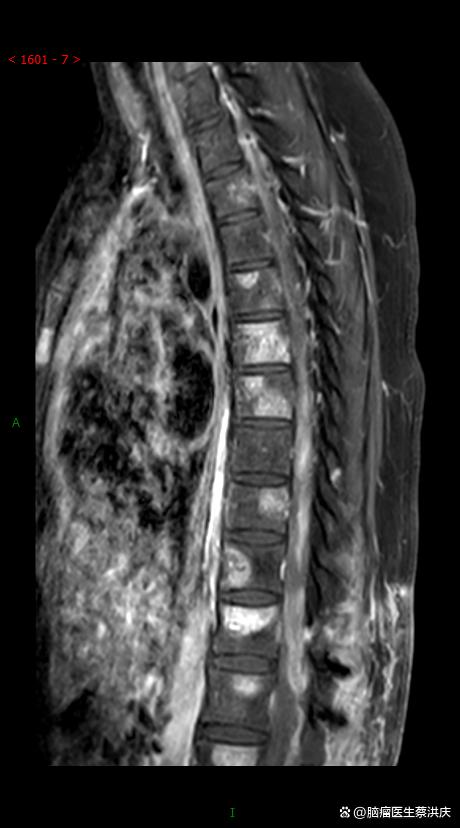胶质瘤是癌症吗?