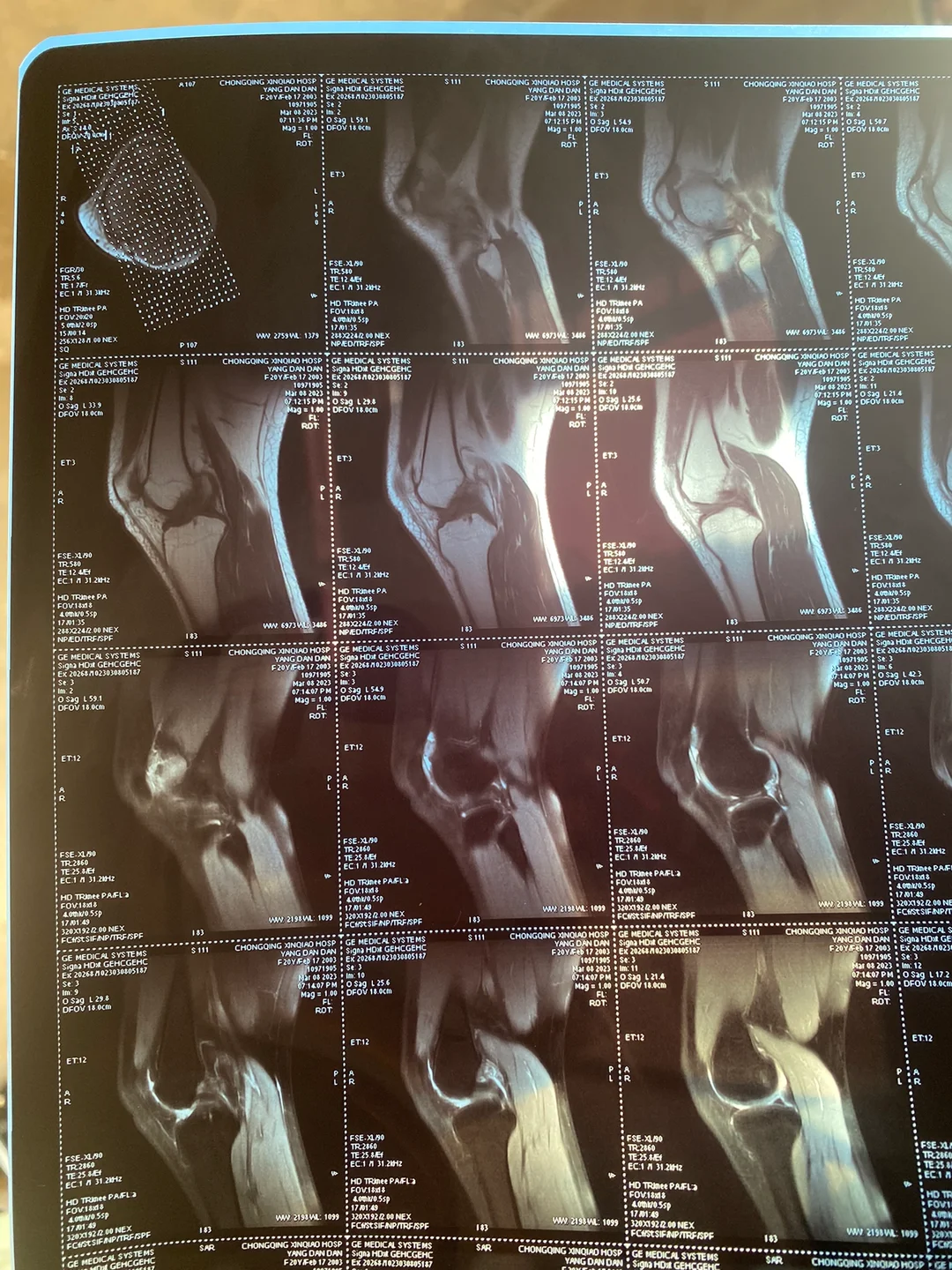 半月板后角撕裂MRI表现