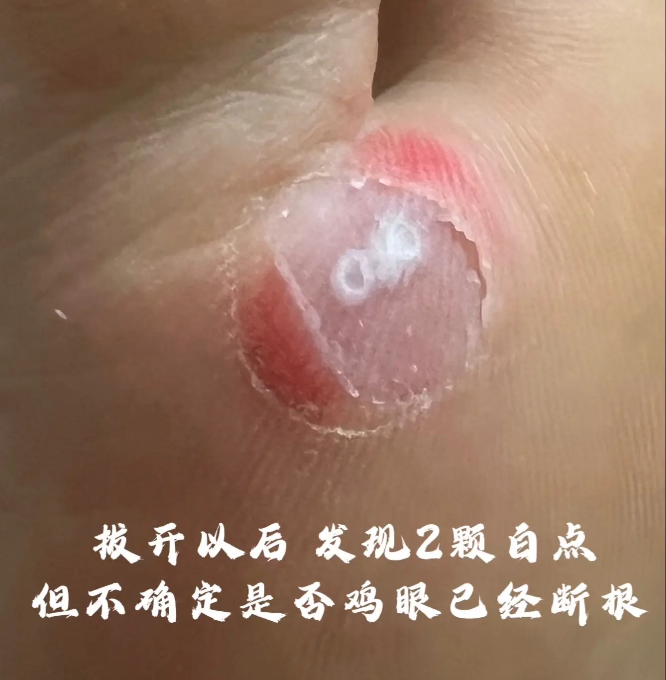 脚上长鸡眼怎么办?