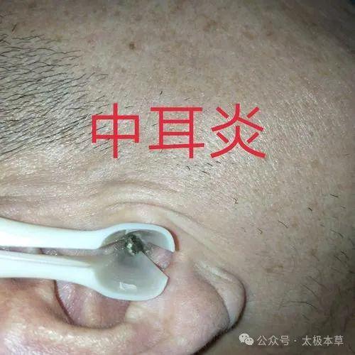 化脓性中耳炎怎么治疗?