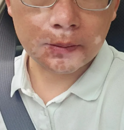 脸上有白块是怎么回事