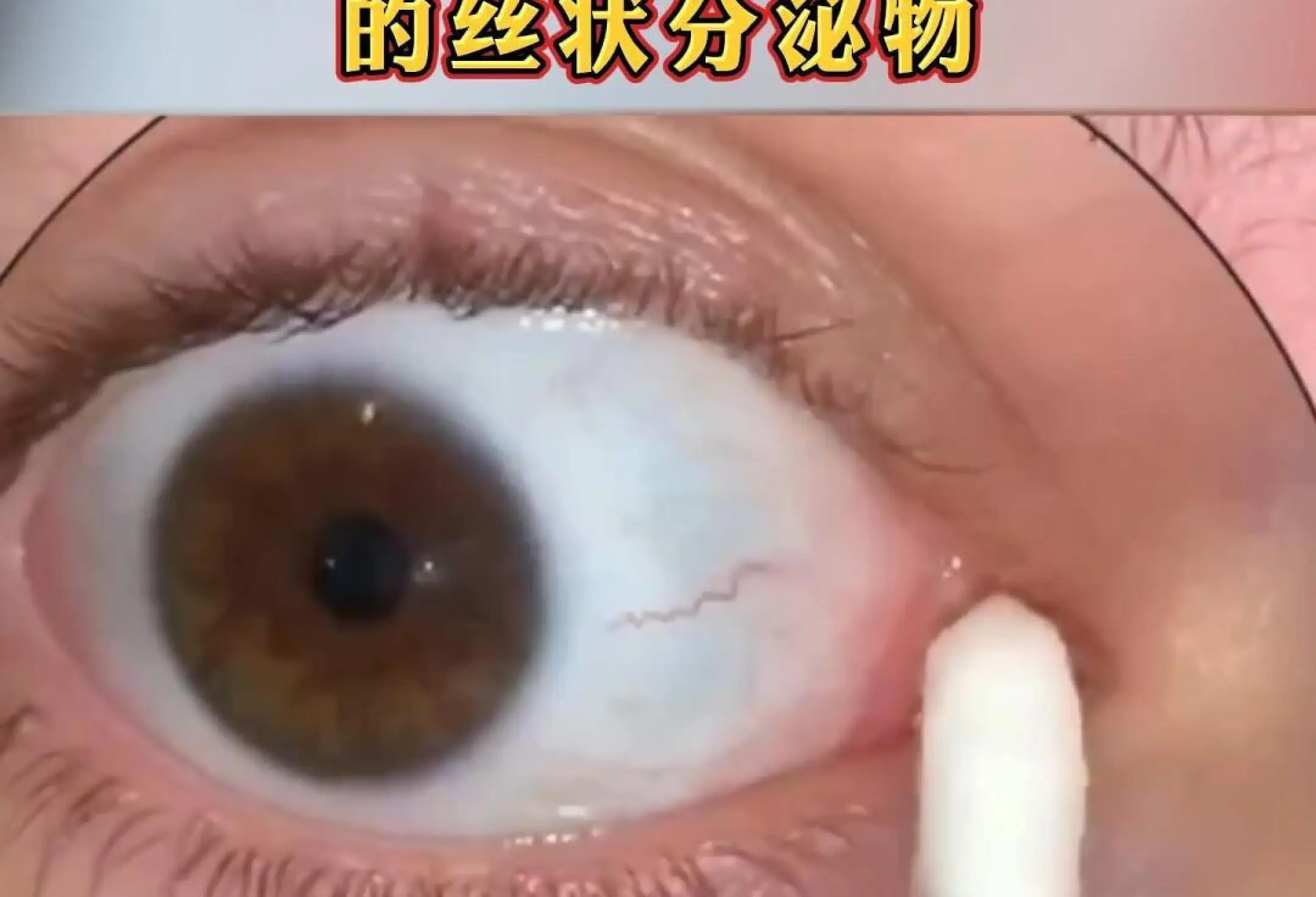 滤泡性结膜炎能自愈吗