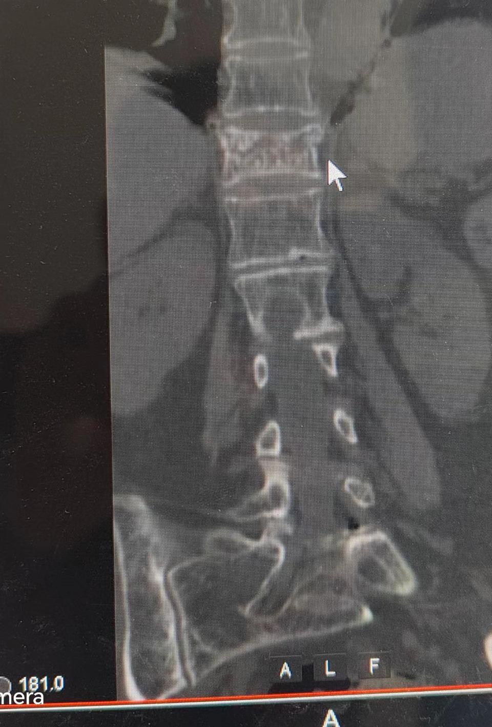 胸椎压缩性骨折症状