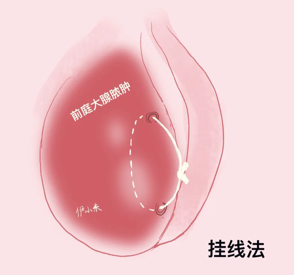前庭大腺囊肿怎么消肿?