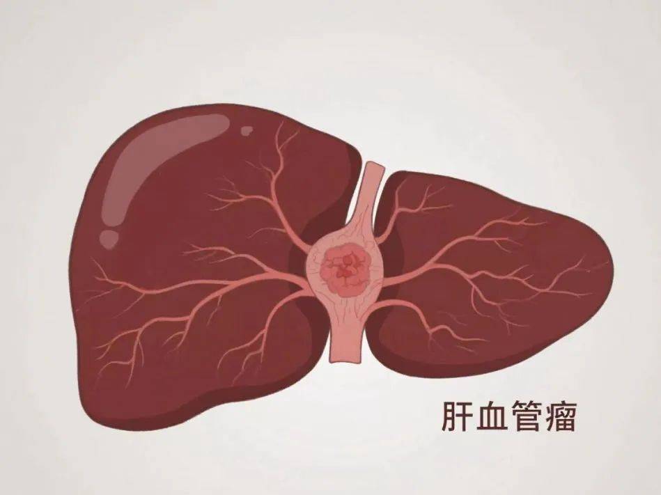 肝血管瘤会变成肝癌吗?