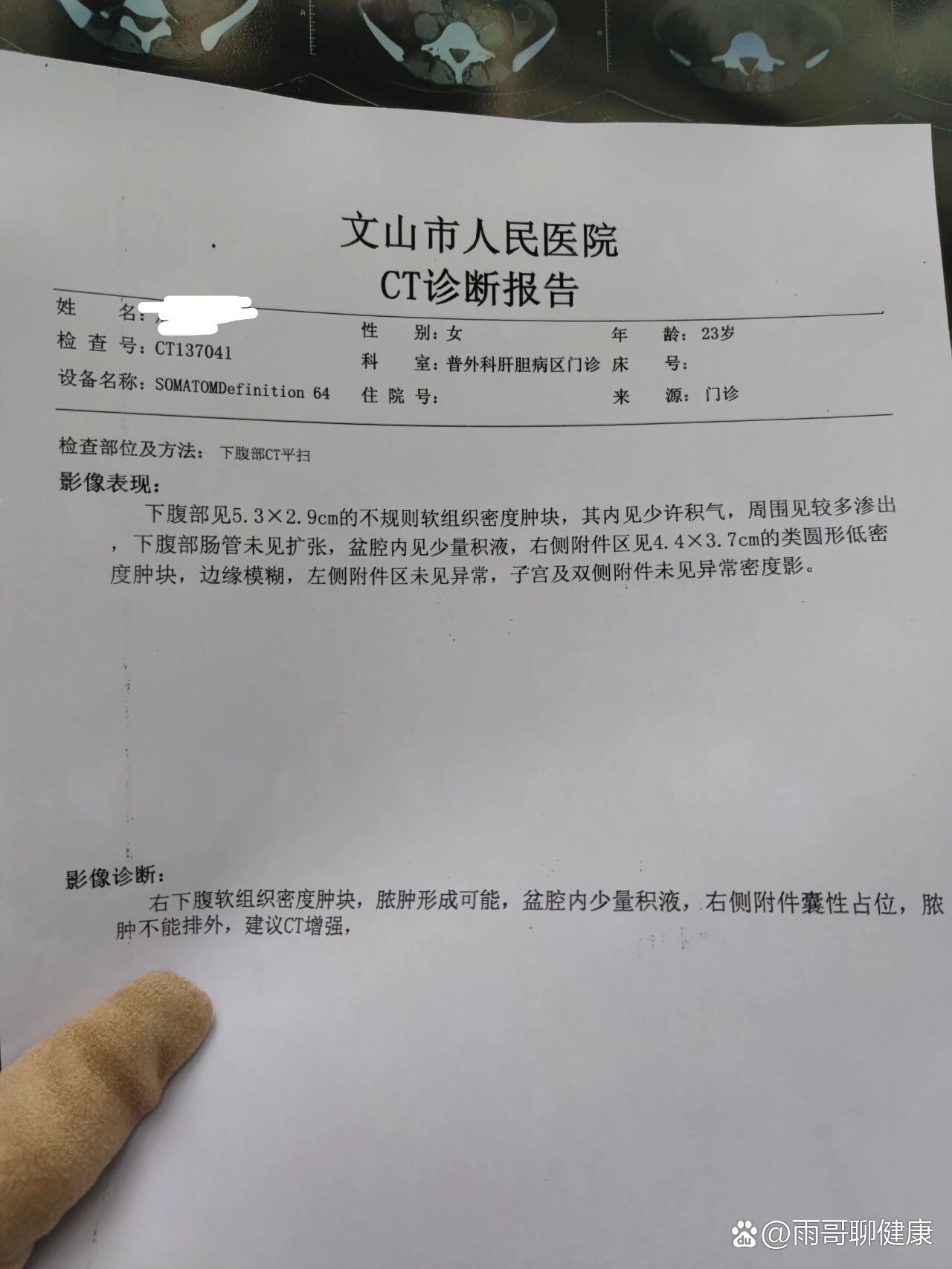 阑尾手术要多少钱