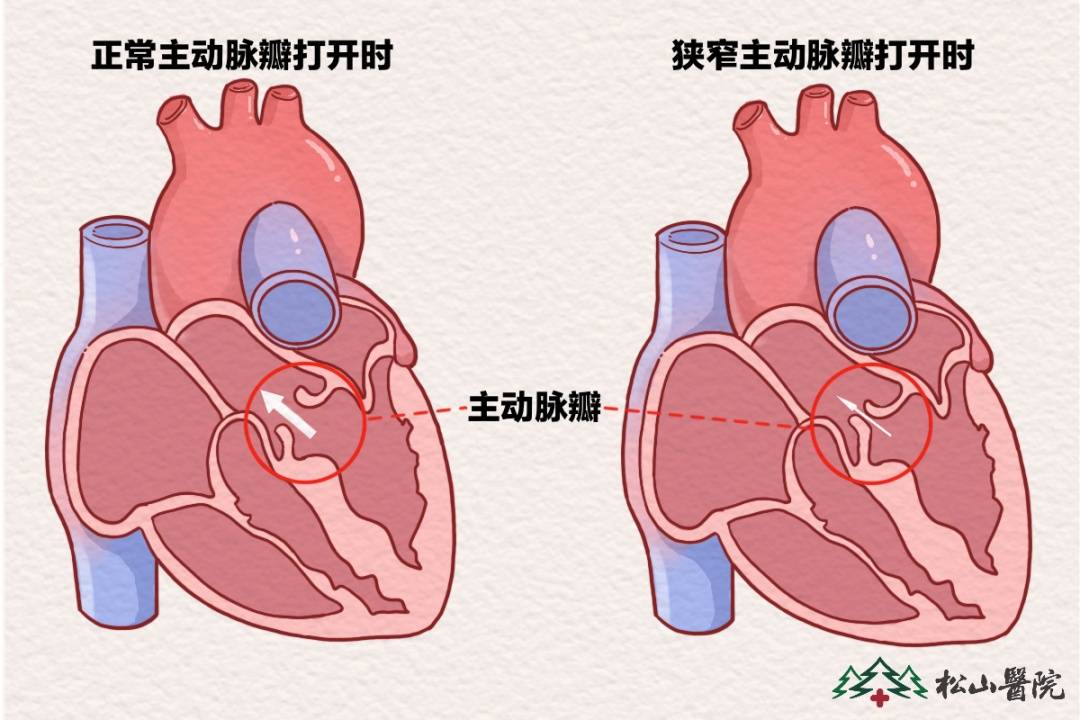 肺动脉瓣狭窄很严重吗