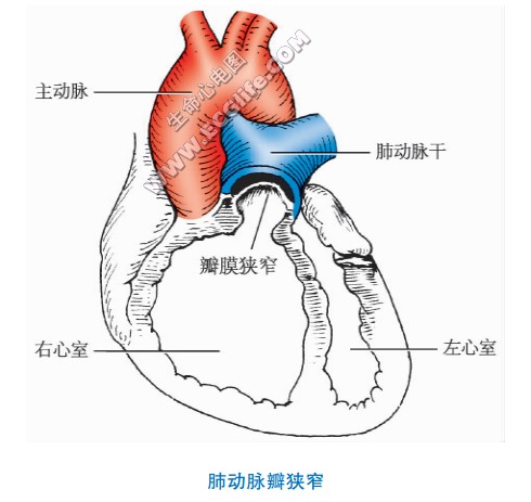 肺动脉瓣狭窄很严重吗