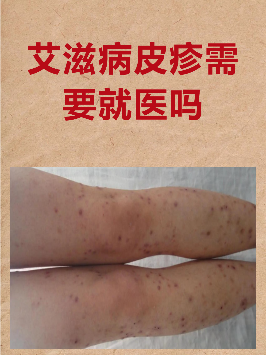 艾滋病急性期皮疹会持续多久