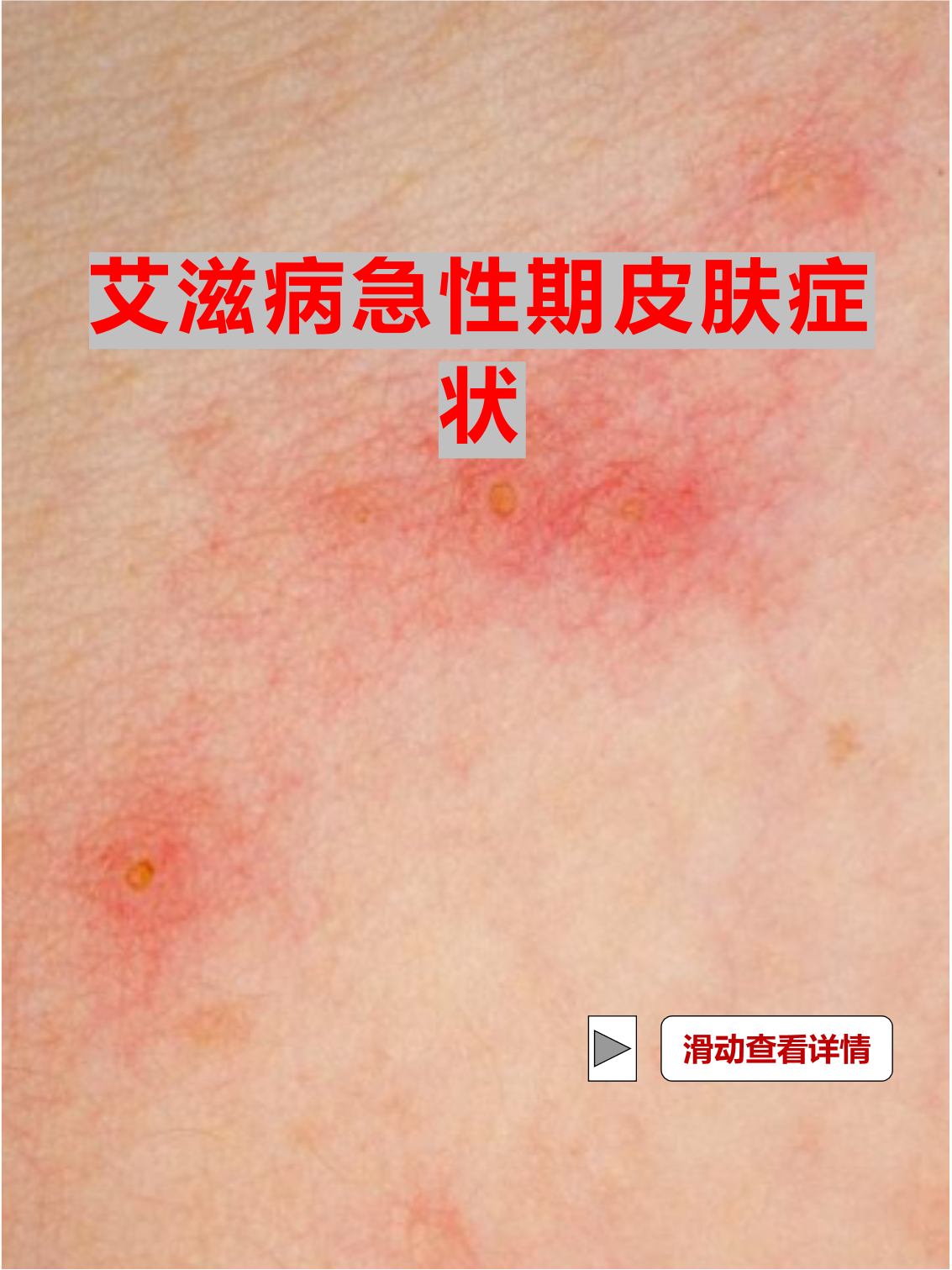 艾滋病急性期皮疹会持续多久