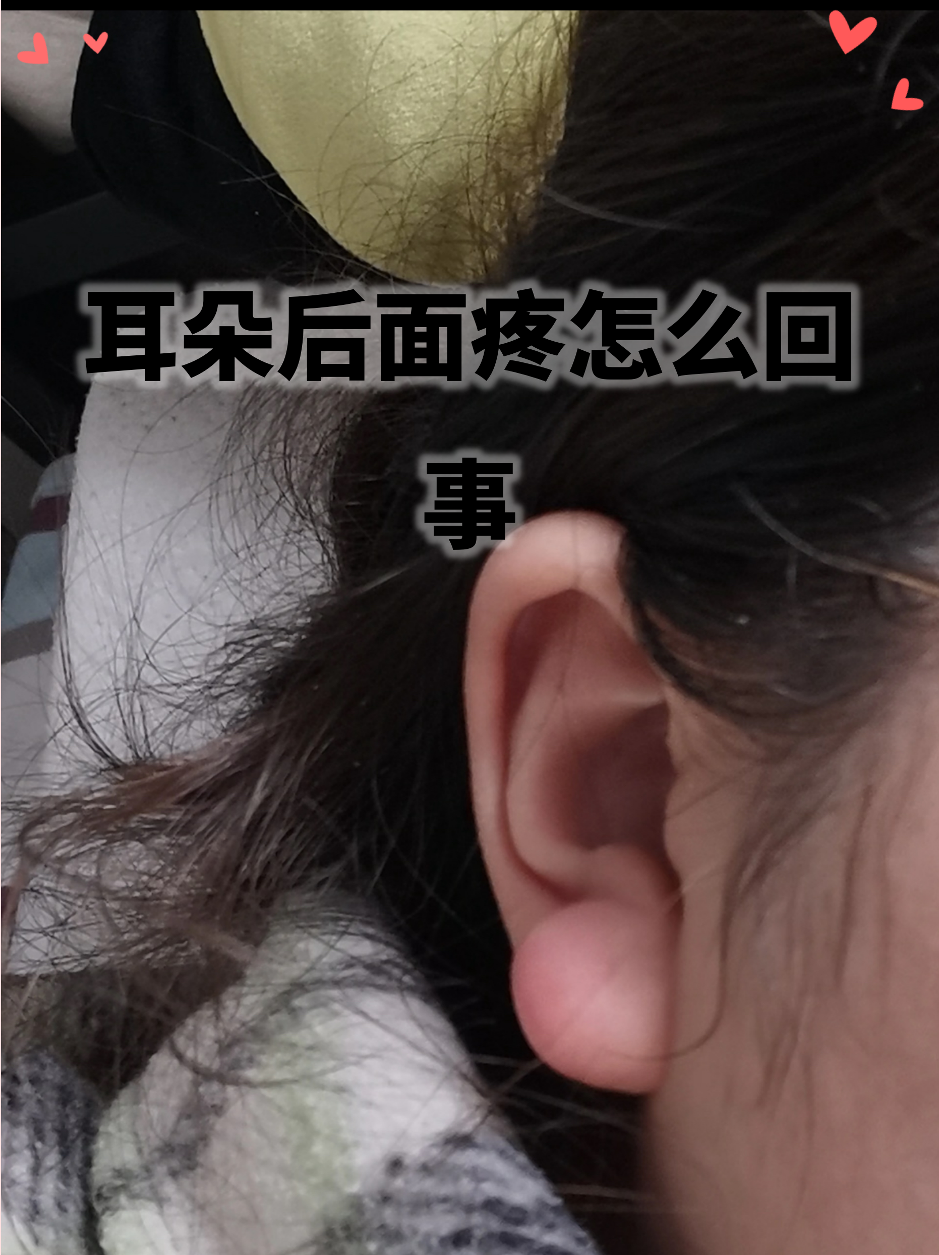 耳朵出血怎么回事但不疼痛