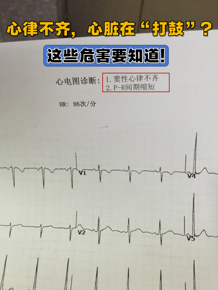 心脏心率不齐怎么回事