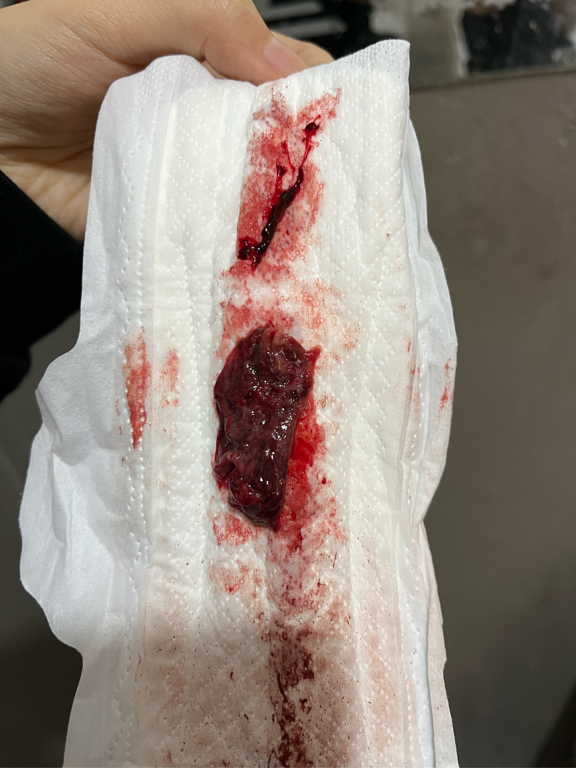 我今天吃了米索前列醇,孕囊排出来了,