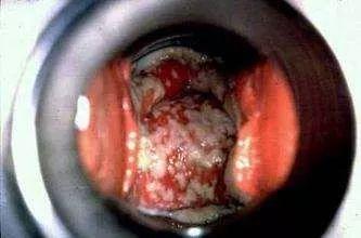 外阴瘙痒白带像豆腐渣