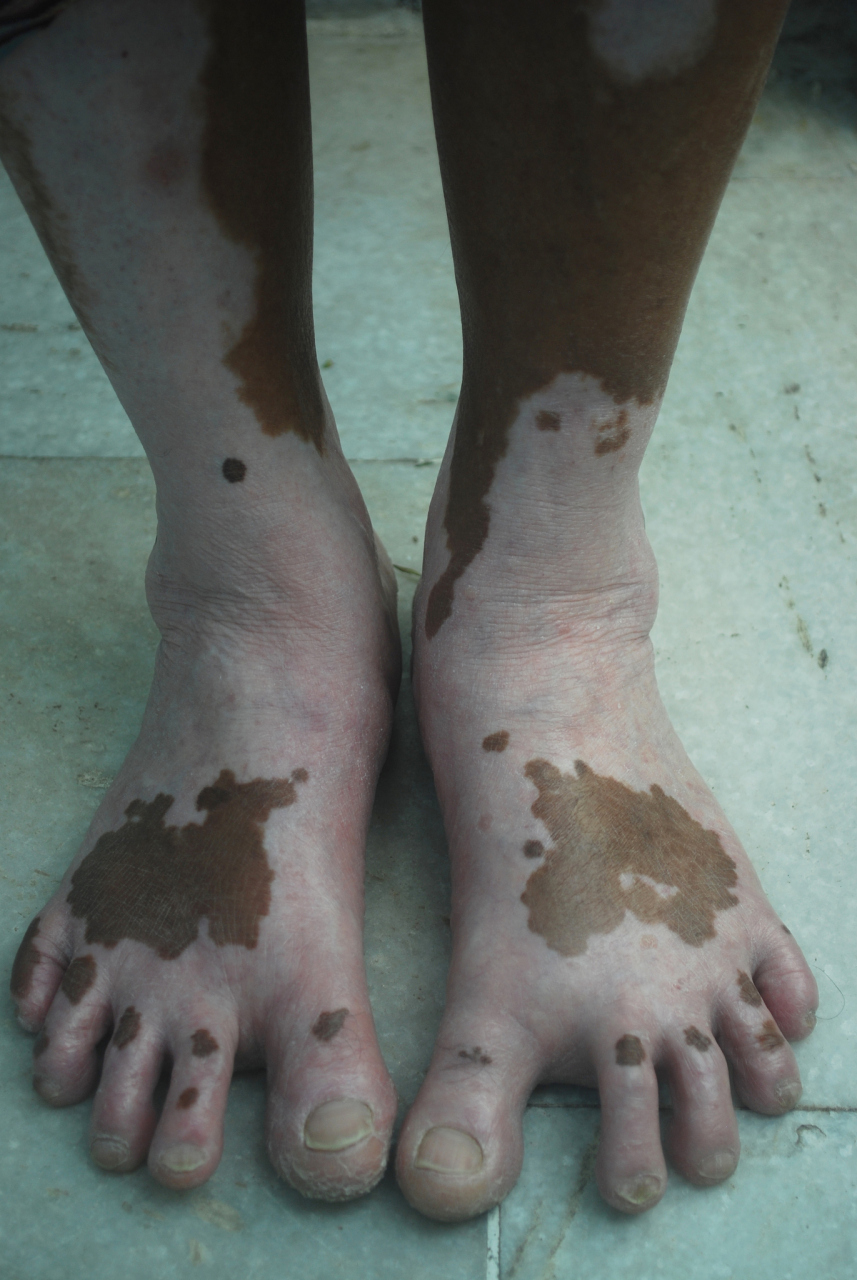 亚急性联合变性症