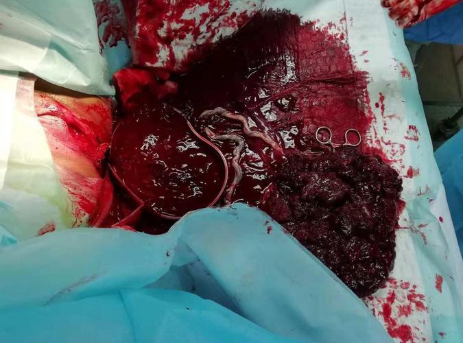 胎盘功能2级能顺产吗