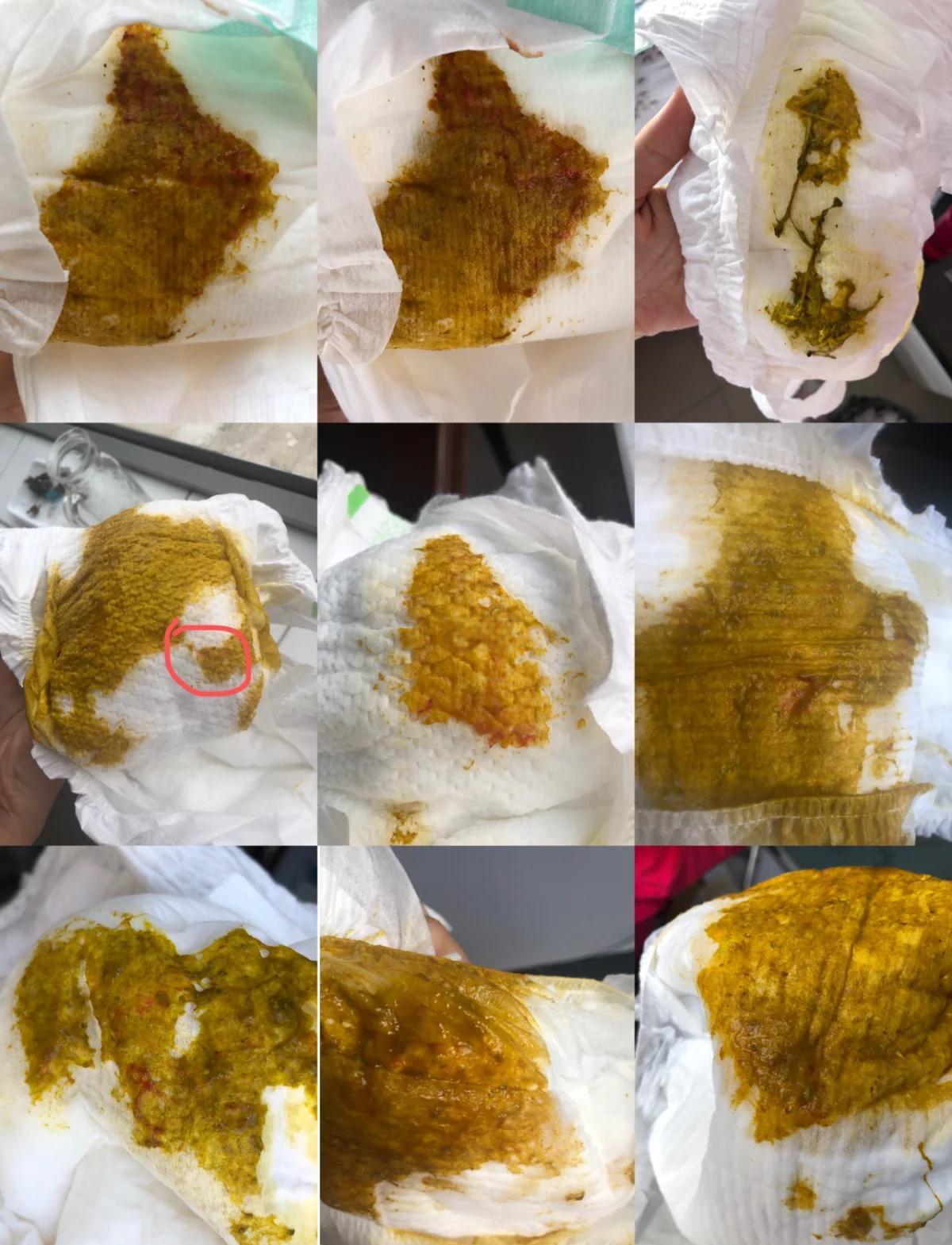 宝宝大便有血丝怎么办?