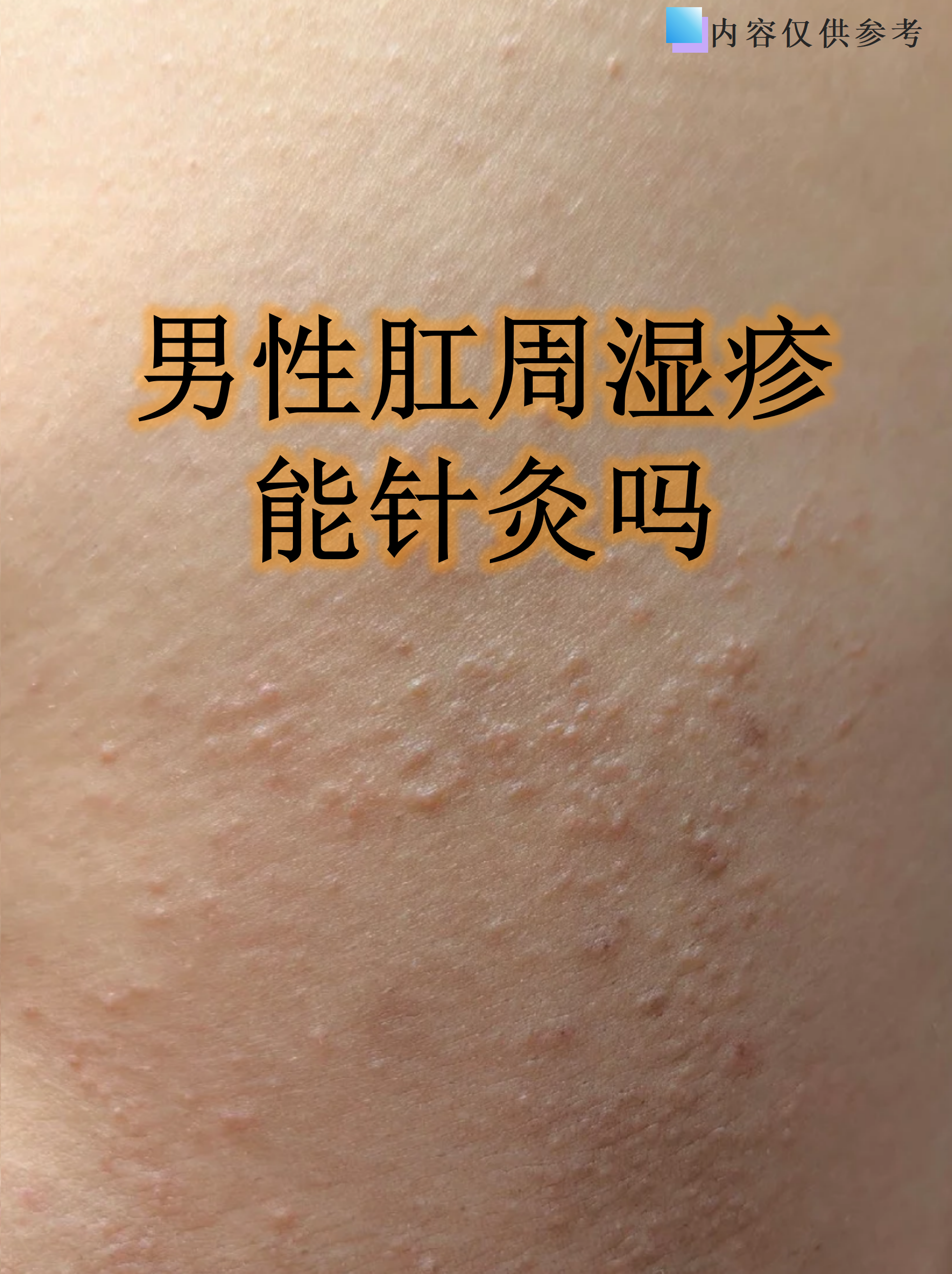 肛门湿疹可以彻底治愈吗