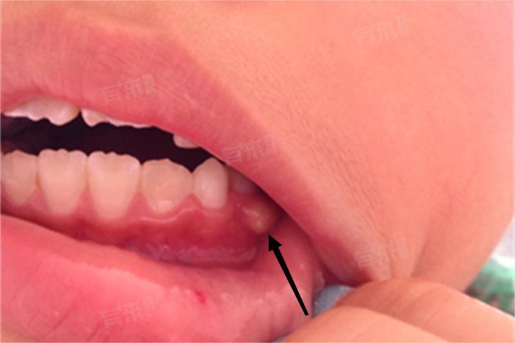 牙齿旁边长了个肉疙瘩