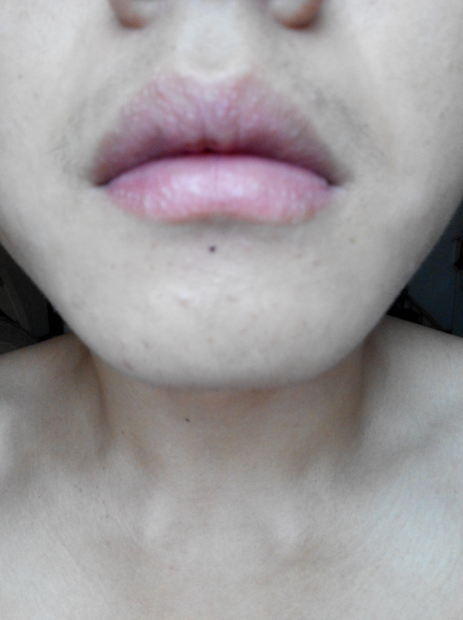 嘴唇长小颗粒是粉刺吗