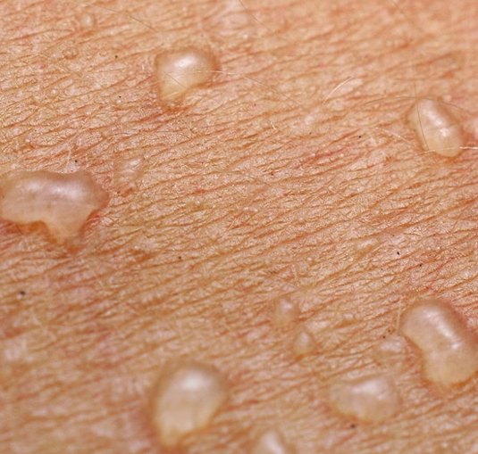 手上起小水泡,不痛不痒